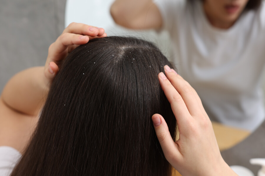 Причины возникновения перхоти